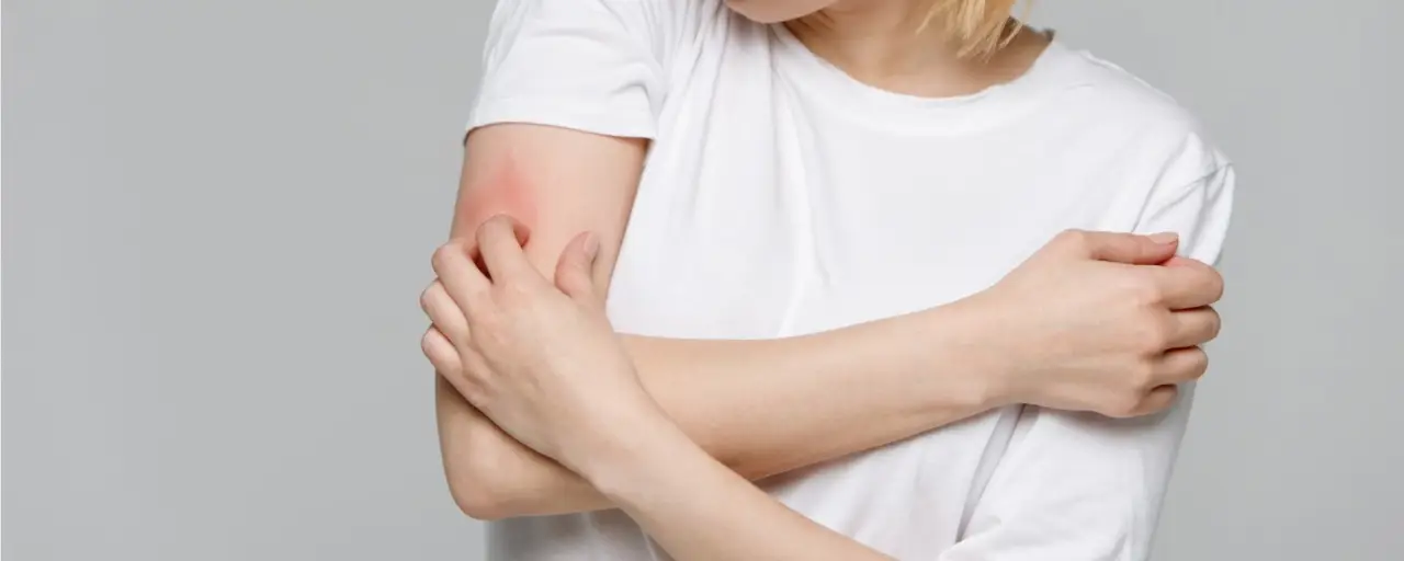 Allarme acari: se hai questo prurito e queste macchie sulla pelle potresti essere infestato